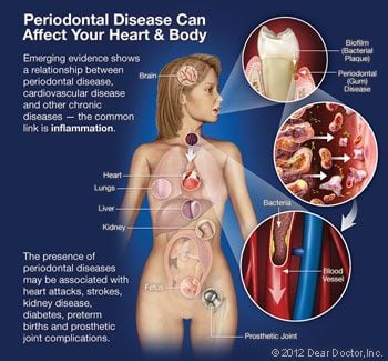 Gum disease can affect your heart and body.