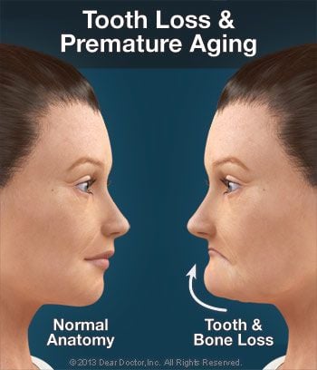 Tooth loss and premature aging.