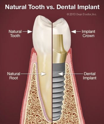 Natural tooth vs dental implants.