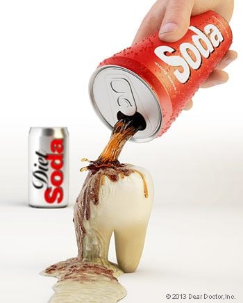 Soda and tooth erosion.
