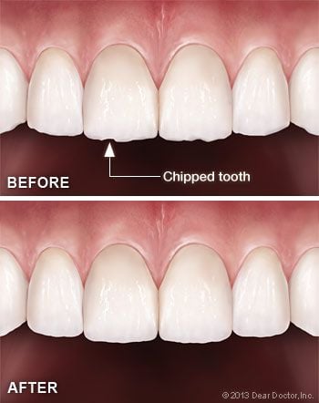 Tooth contouring and reshaping.