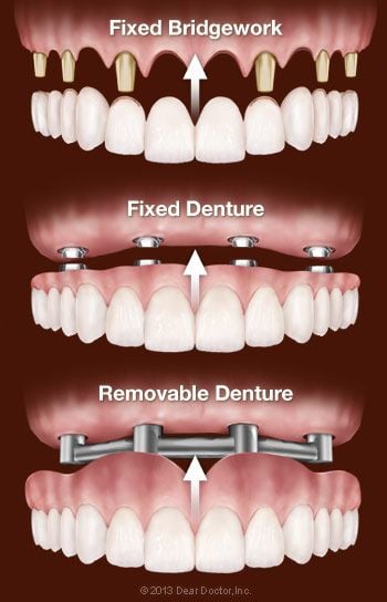 Options for replacing all teeth with dental implants.