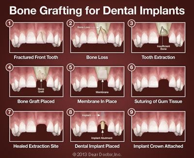 Bone grafting for dental implants.
