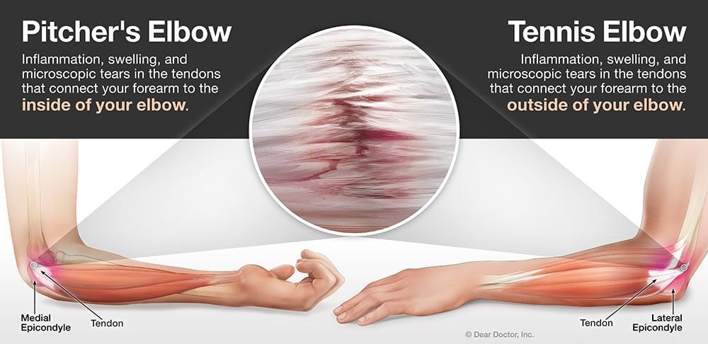 Pitcher's elbow vs Tennis Elbow Chiropractic Basalt Aspen Carbondale