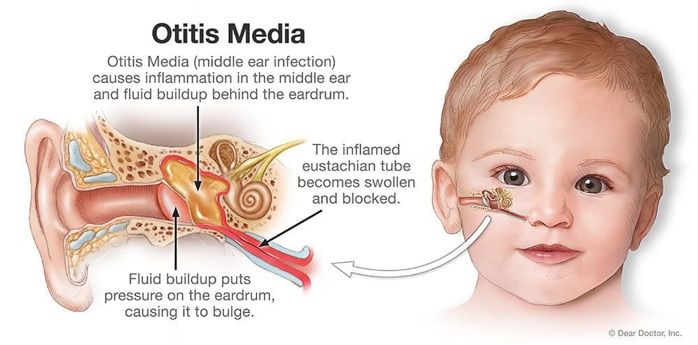 ear infection in children