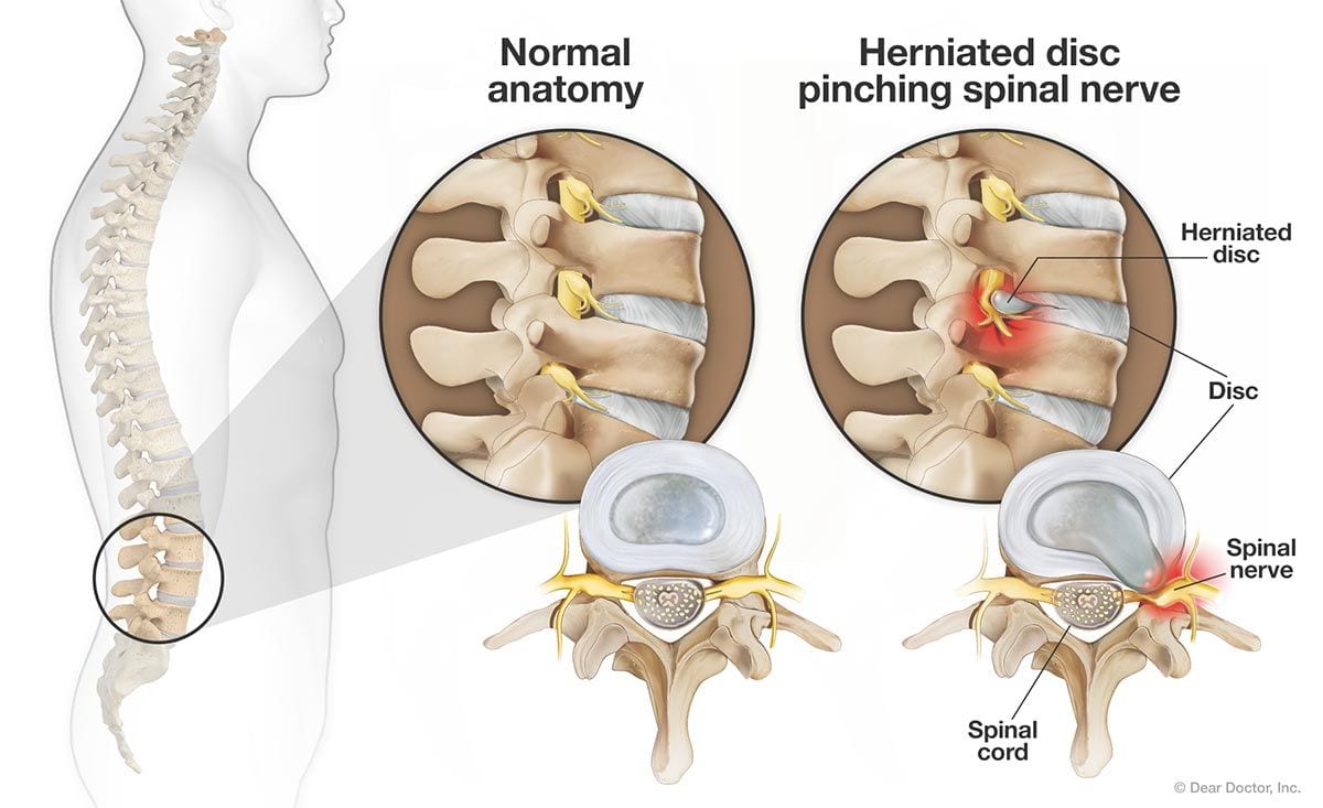 Pinched Nerve Signs - Walk-In Back and Neck Pain Relief South Shore