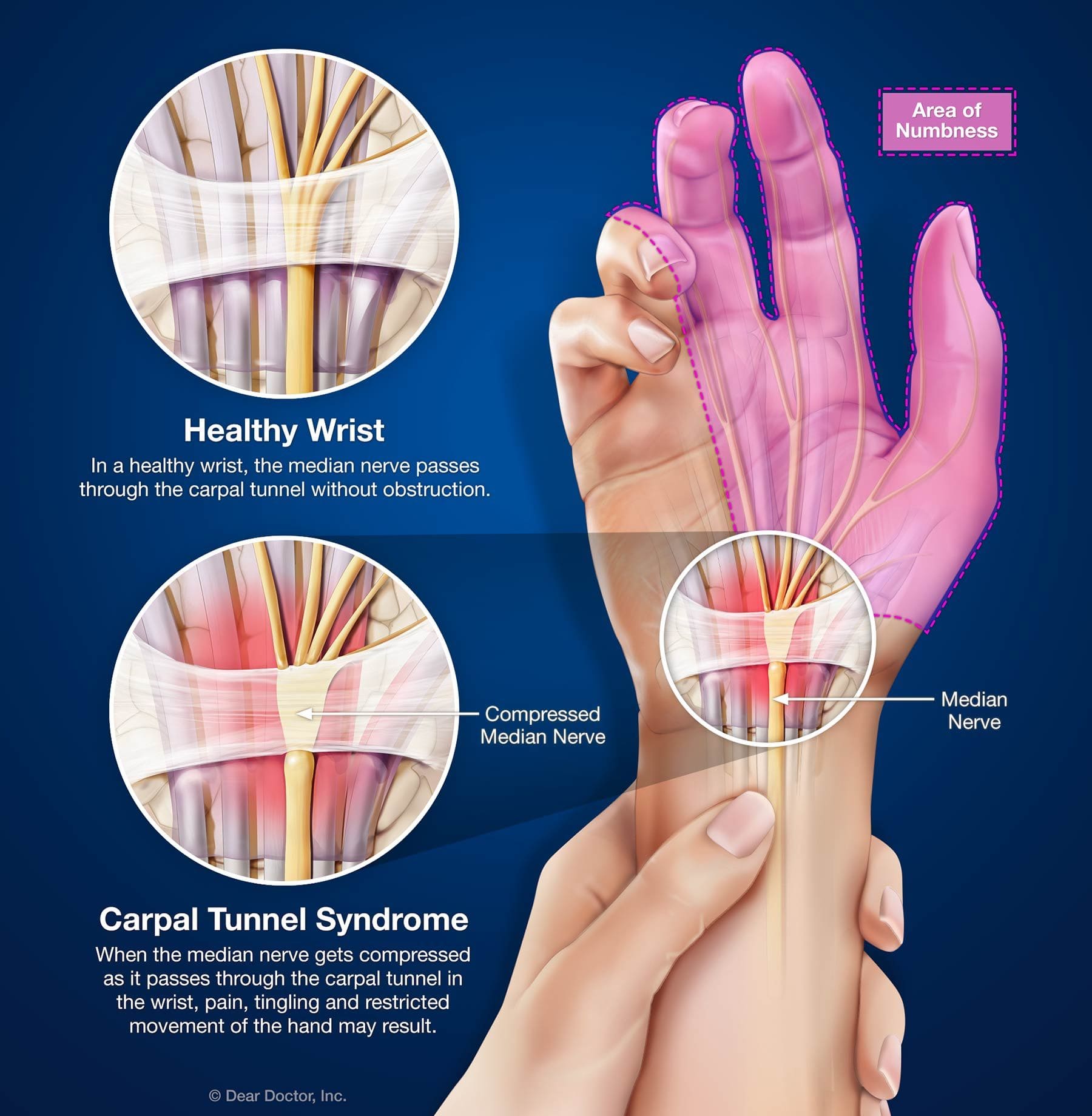 Carpal Tunnel Syndrome, Chiropractor in Richland, WA