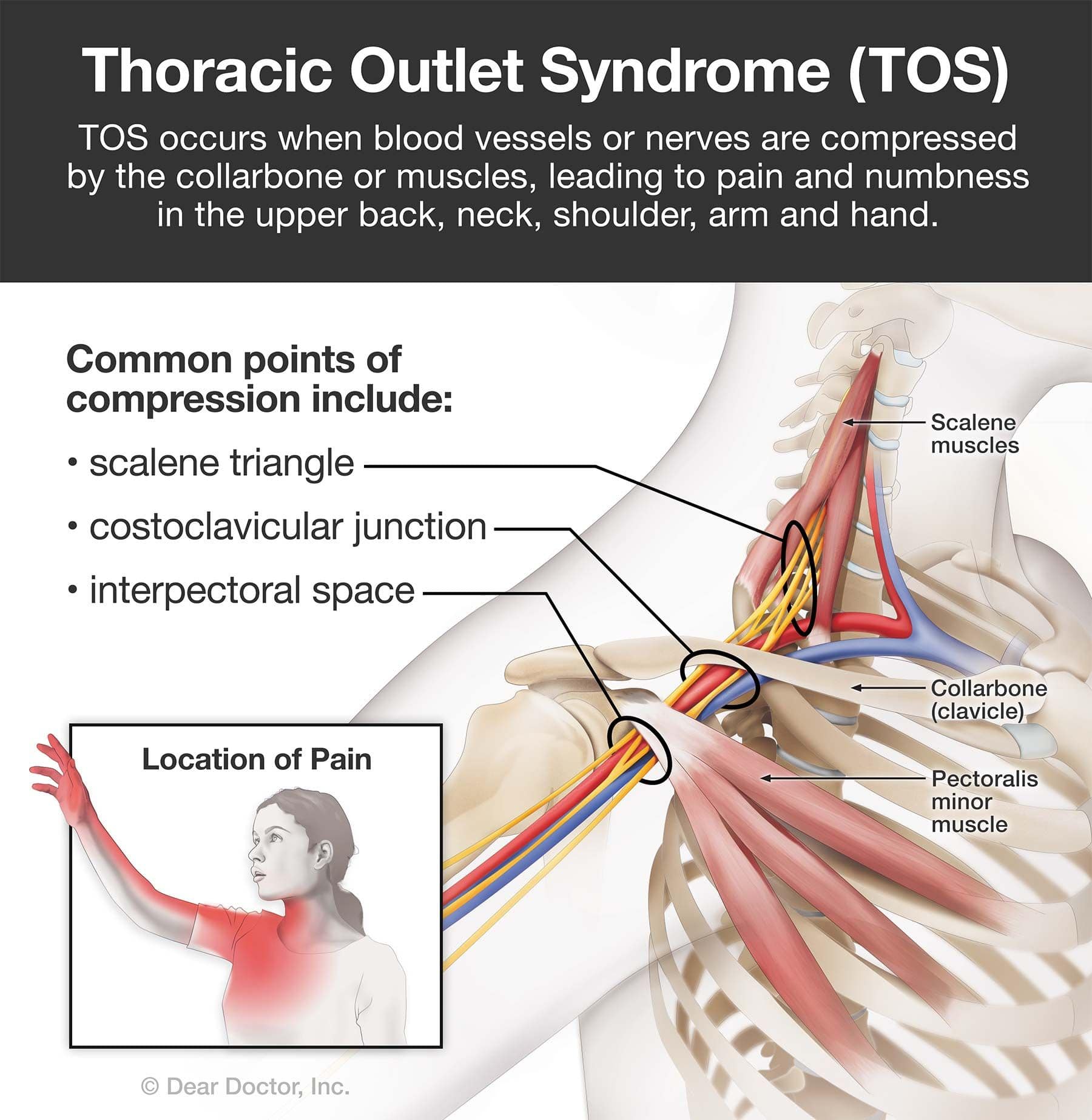 Thoracic Outlet Syndrome: More Than Just a Pain in the Neck – The Nicholas  Institute of Sports Medicine and Athletic Trauma