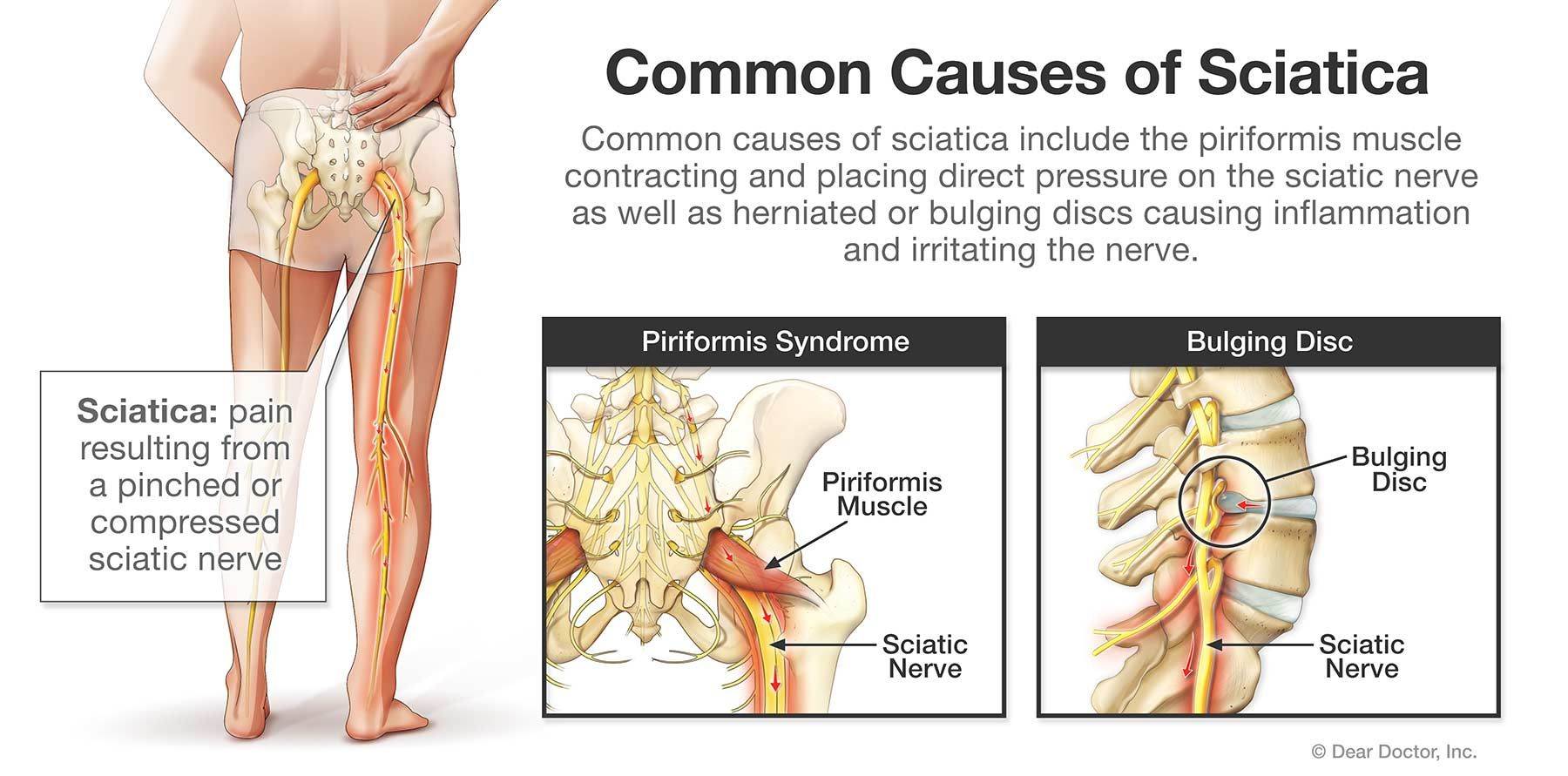 Sciatica Sports Chiropractor In Guilderland Ny