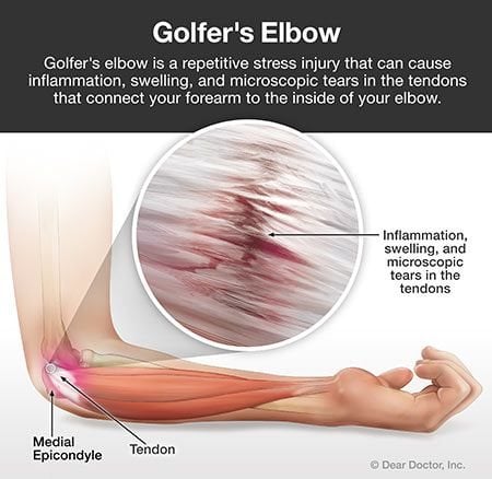 Golf elbow.