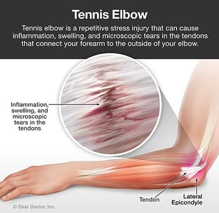 Elbow deals forearm pain