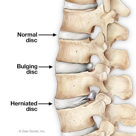 Bulging and herniated disc Chiropractic Basalt Aspen Carbondale