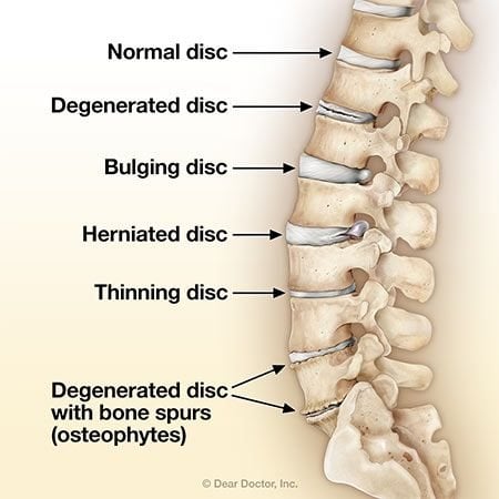 degenerative disc in thoracic spine