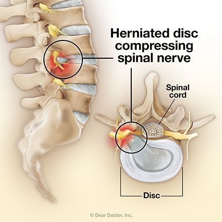 degenerative disc in thoracic spine