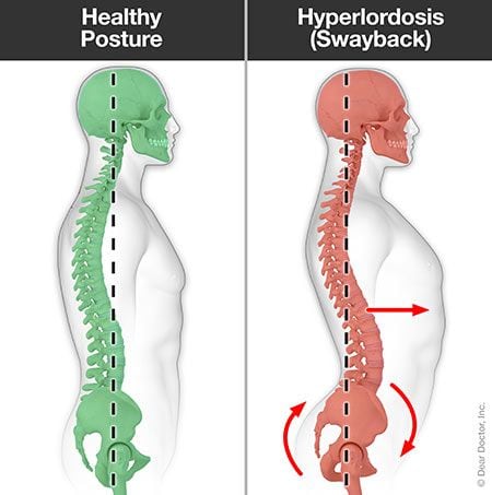 Hyperlordosis (swayback).