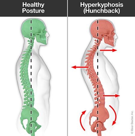 Hyperkyphosis (hunchback).