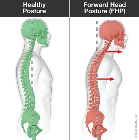 forward head posture before and after