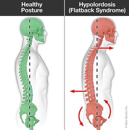 Hypolordosis (flatback syndrome).