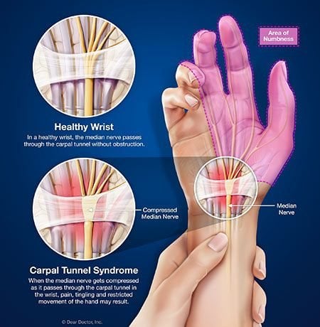 3 Treatments for Carpal Tunnel Syndrome and how Chiropractors can help.