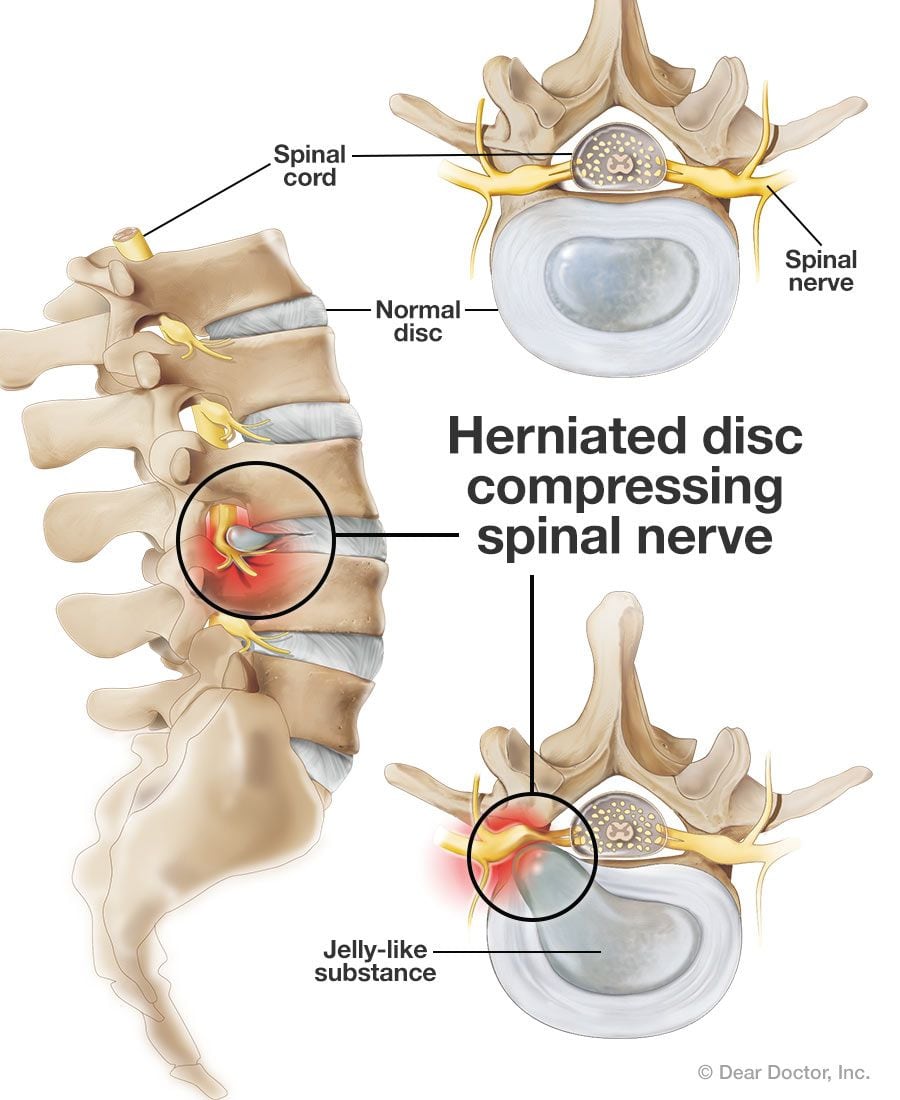 spine with disk map