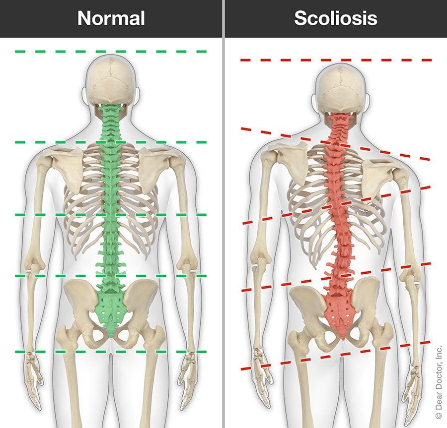 Scoliosis Chiropractor In Calumet City Il Es3 Fitness Rehab 6701