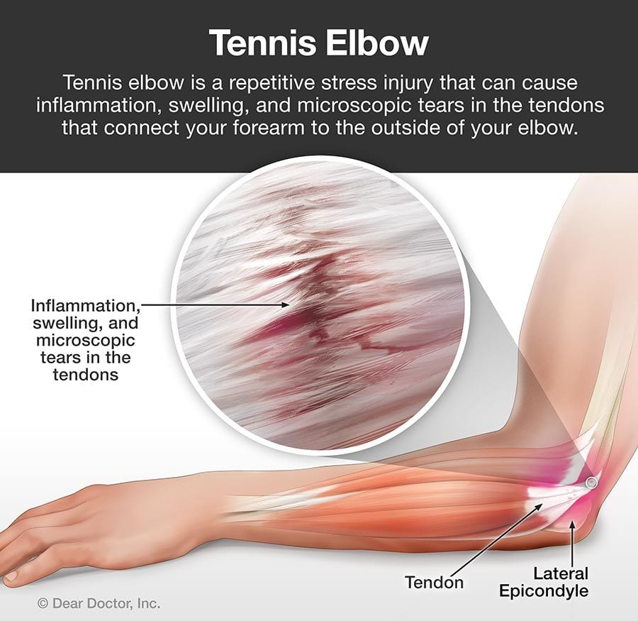 Tennis Elbow 2x 514762 