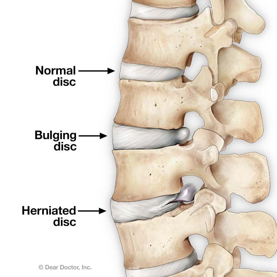 Bulging And Herniated Discs Chiropractor In Calumet City Il Es3 Fitness Rehab 4769