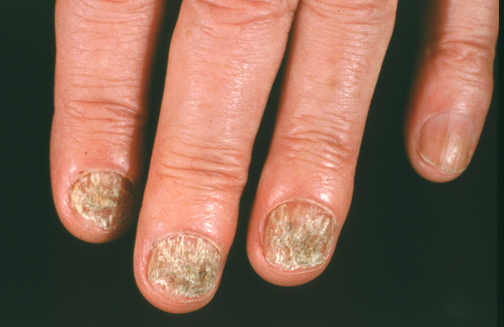 Nail Fungus Dermatologist In Pensacola FL Summit Dermatology Med Spa