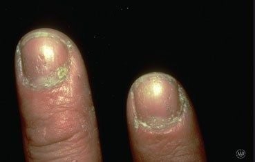 psoriasis-nails.jpg