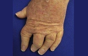 psoriatic-arthritis-hand.jpg