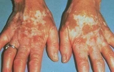 Vitiligo_symptoms_hands.jpg