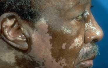 vitiligo_symptoms_face.jpg