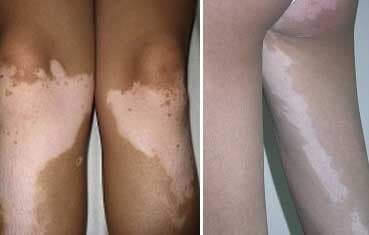 vitiligo_symptoms_types.jpg