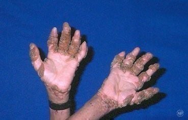 warts on hands teenager