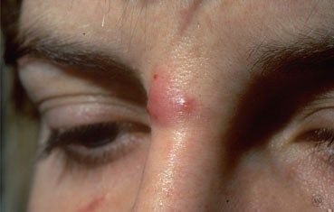 acne cyst nose