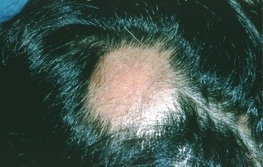 Alopecia-areata_symptoms_bald-patch-male.jpg