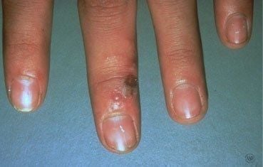 herpes-simplex-symptoms-hands.jpg