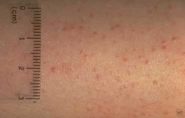 Keratosis Pilaris Dermatologist In Murfreesboro Tn Charles E Goodman Jr Md