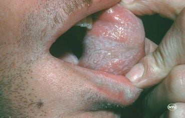 lichen-planus-symptoms_oral.jpg