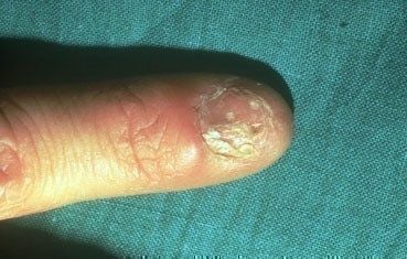 lichen-planus-symptoms_fingernail.jpg