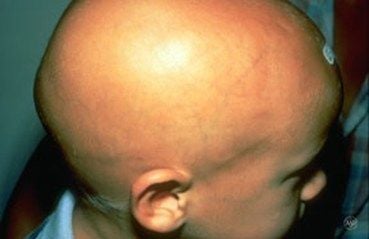alopecia-areata-total.jpg