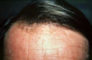 hair-loss_treatment_transplant_after.jpg