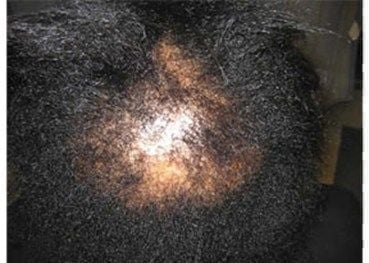 hair-loss-treatment_woman.jpg