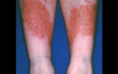 diabetic dermopathy legs pictures