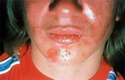 cold-sore-causes-outbreak.jpg