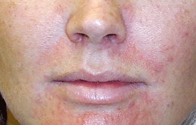 acne-perioral-dermatitis-acne1.jpg