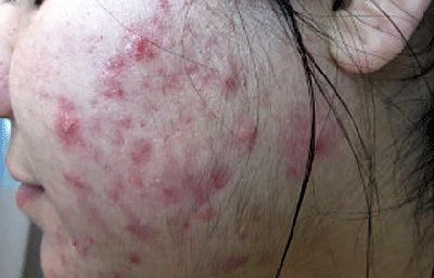 acne-polycystic-ovary-syndrome.jpg