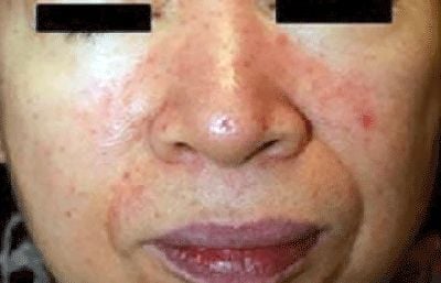 acne-papulopustular-rosacea.jpg