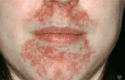 acne-perioral-dermatitis-acne2.jpg