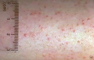 keratosis-pilaris.jpg